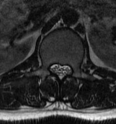 Achondroplasia Short Pedicles